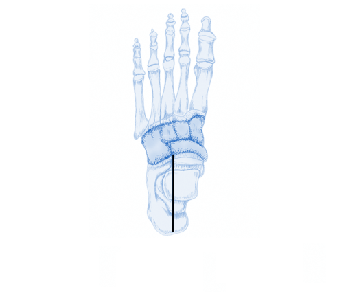 Osteoarthritis