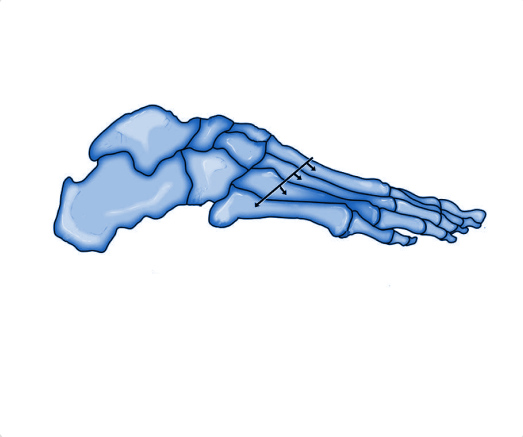 cuboid subluxation