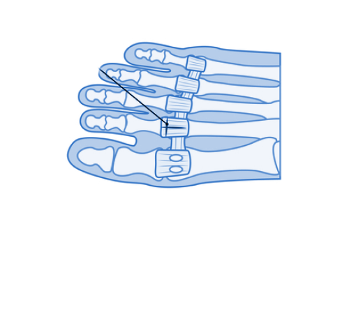 plantar plate injuries