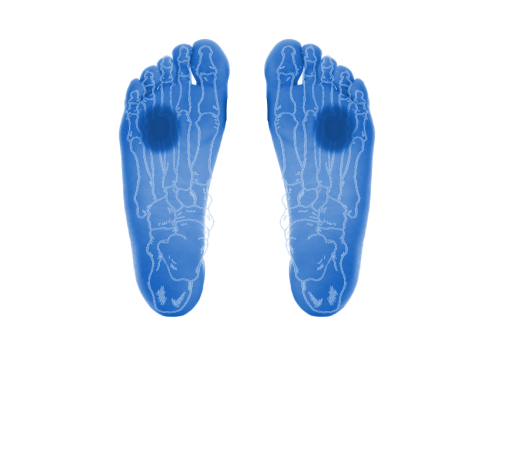 morton’s neuroma