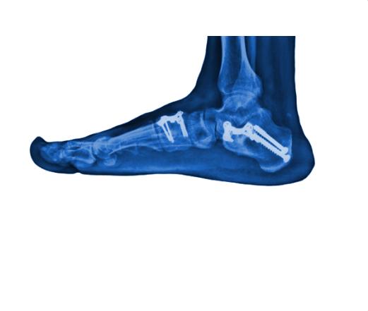 tarsal tunnel syndrome