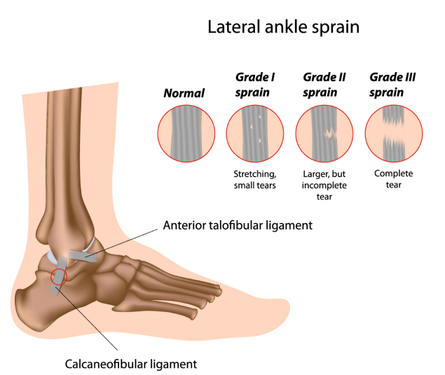 Lateral ankel sprain