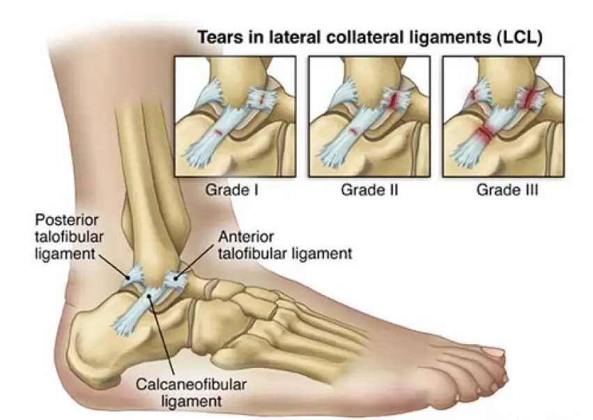 Ankle Sprains