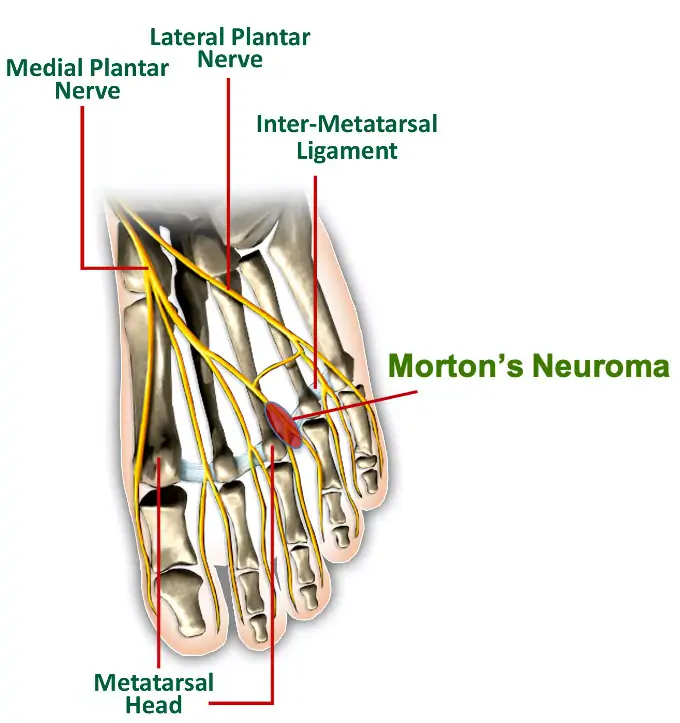 Mortons neuroma