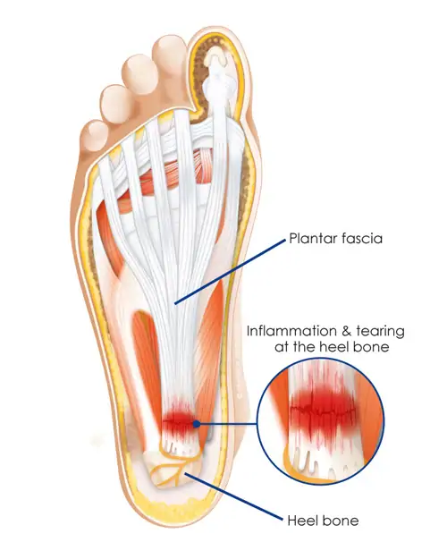 Plantar Fasciitis