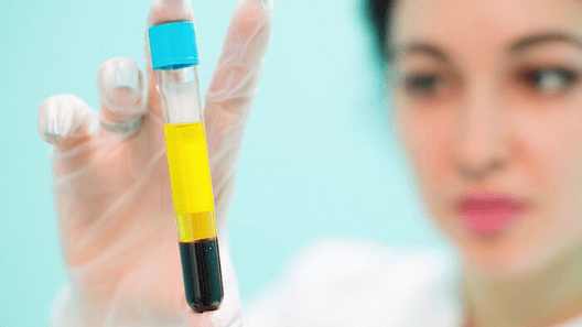 Platelet Rich Plasma
