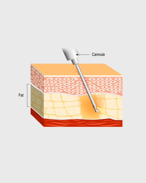 fat-aspirate