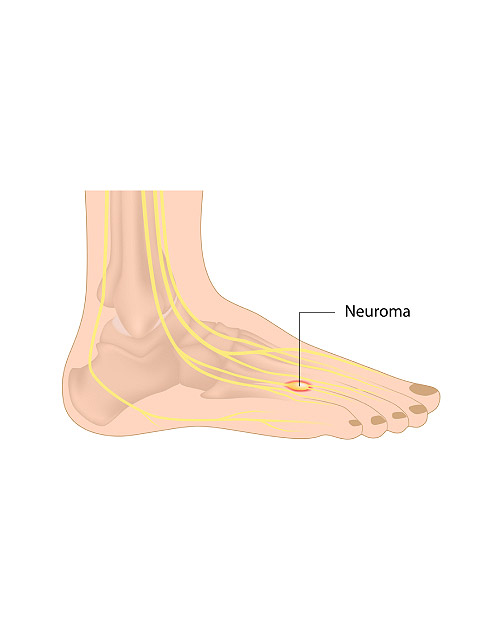 Mortons Neuroma