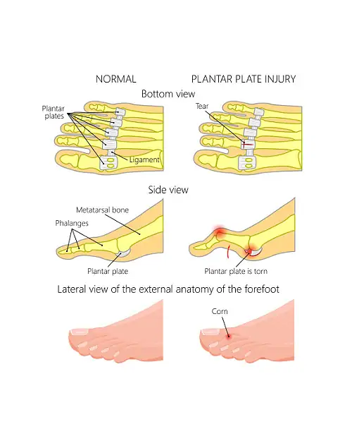 Plantar Plate Tear Left