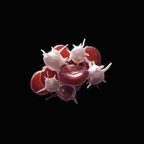 Plantar Plate Tear Right