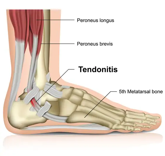 Peroneal tendonitis