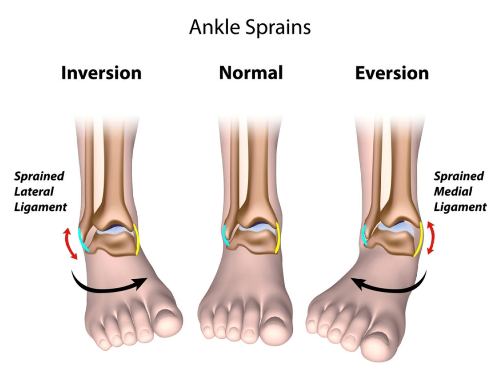 ankle sprains