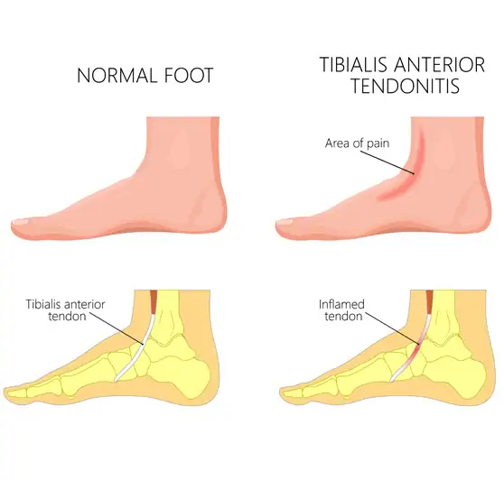 Tibialis Anterior Tendonitis