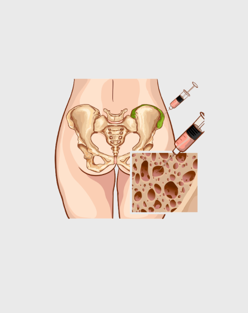Bone Marrow Aspirate